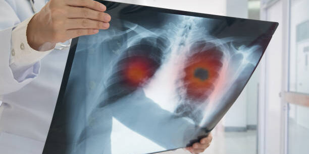 Lung Cancer. Doctor check up x-ray image have problem lung tumor of patient.